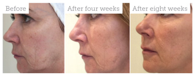 profhilo skin boosting injections, hertfordshire and essex skin clinic