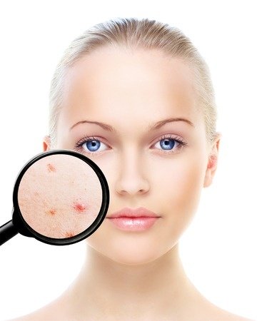 acne treatments, hertfordshire, essex