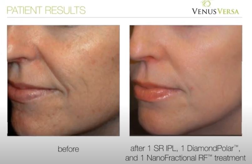 Skin Pigmentation Treatments, Venus Versa, Top Skin Clinic in Hampshire