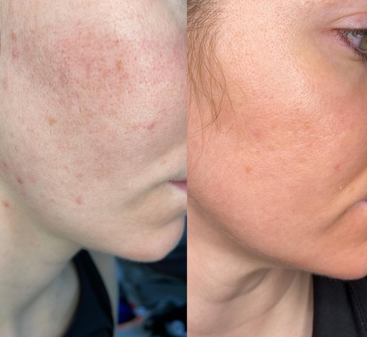 before and after venus versa skin resurfacing skin clinic at urban spa in bishops stortford hertfordshire
