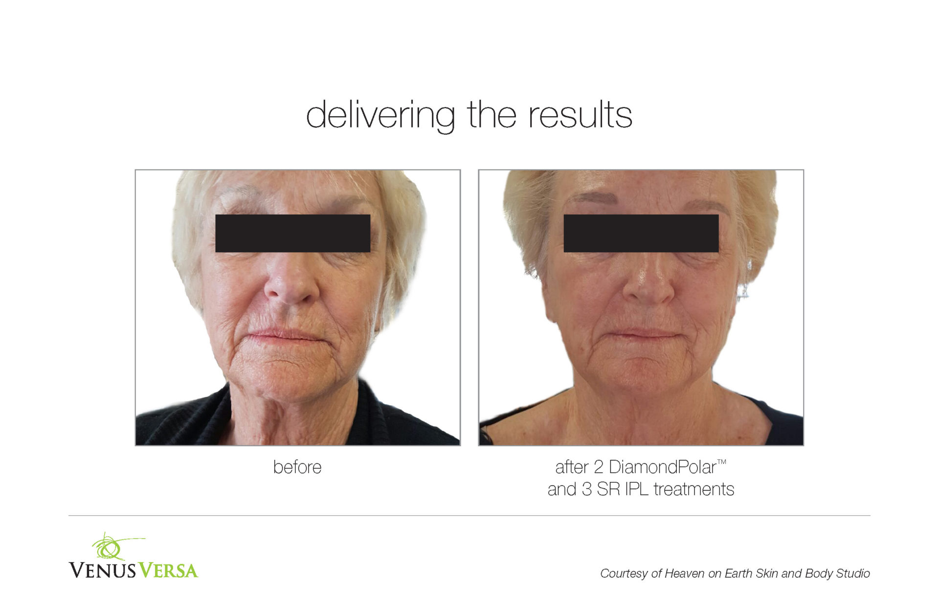 VenusVersa Wrinkle Reduction Treatments In Hertfordshire and Essex VenusVersa Wrinkle Reduction Treatments In Hertfordshire and Essex