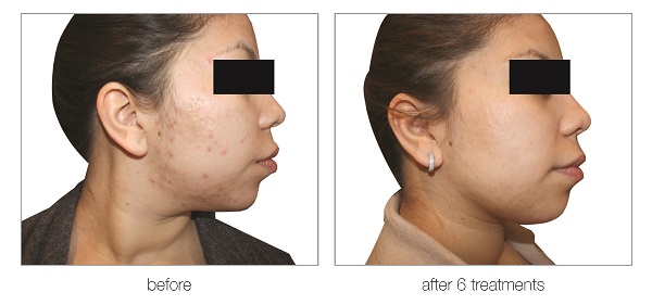 venus versa treatments for acne in hertfordshire