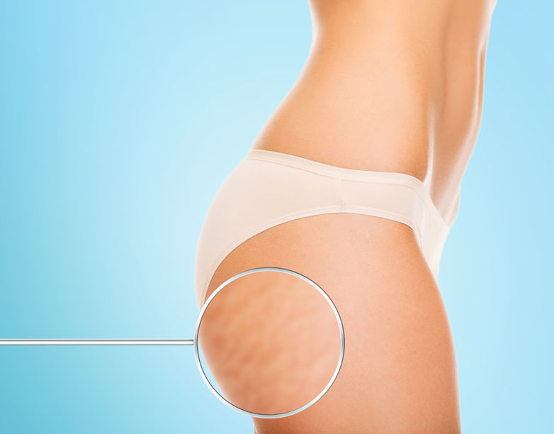 CELLULITE TREATMENTS THAT WORK