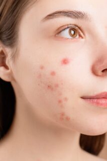 June Is Acne Awareness Month