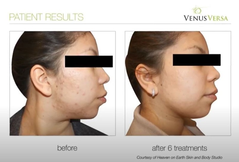 ACNE TREATMENTS WITH VENUS VERSA, The Best Anti-Ageing Salon in Hertfordshire and Essex