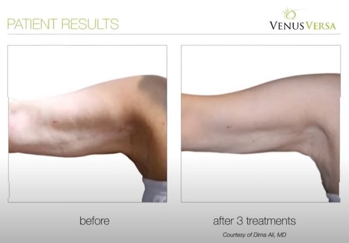 BINGO WING REDUCTION, Venus Versa Treatments, The Skin Clinic at Urban Spa in Bishop's Stortford, Hertfordshire
