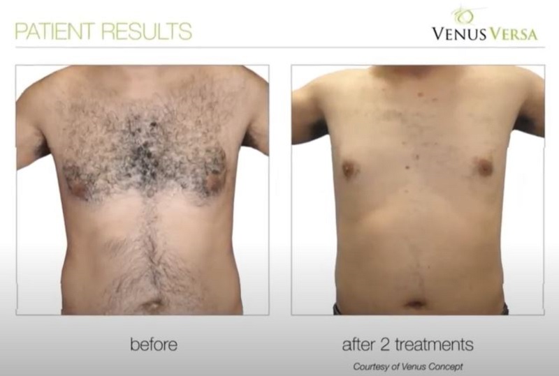 HAIR REMOVAL WITH VENUS VERSA, The skin clinic at urban spa beauty salon in bishop's stortford, hertfordshire