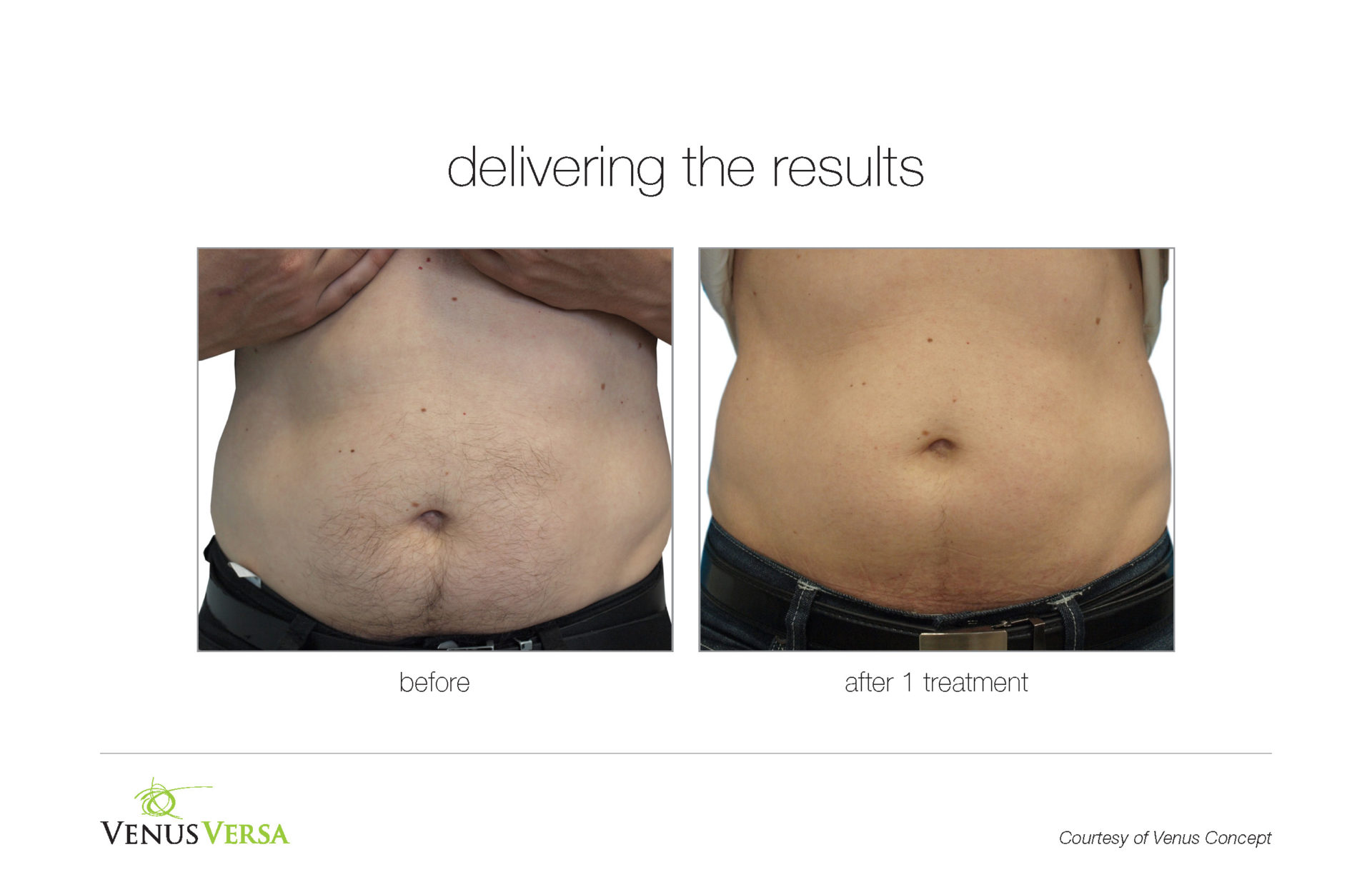 VenusVersa BA HairRemoval VenusConcept 1Tx