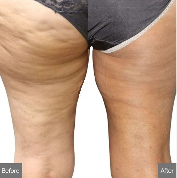 cellulite reduction treatments venus versa best skin clinic in hertfordshire 1