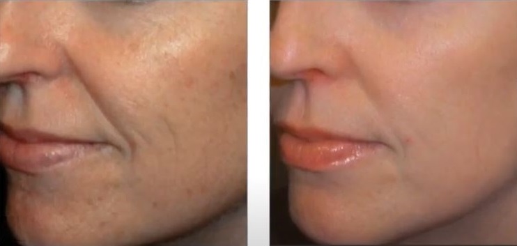 sKIN PIGMENTATION TREATMENTS IN HERTFORDSHIRE - VENUS VERSA, SKIN CLINIC IN BISHOPS STORTFORD