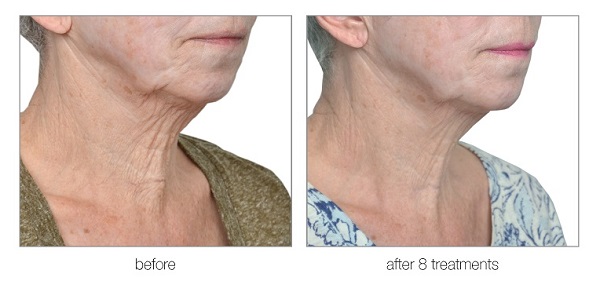venus versa anti ageing face treatments at skin clinic in bishops stortford
