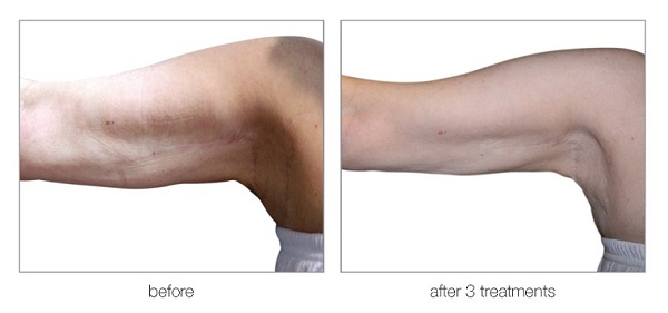 venus versa bingo wings treatments at top beauty salon in hertfordshire