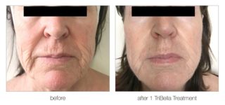 Effective Anti-Ageing Treatments