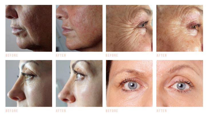 BEFORE AFTER CACI RESULTS