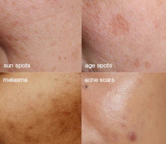 melanopro benefits at skin clinic at urban spa hertfordshire melanopro benefits at skin clinic at urban spa hertfordshire