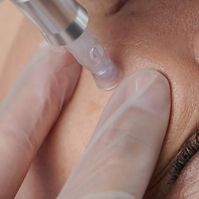 DERMALOGICA MICRONEEDLING AT URBAN SPA BISHOPS STORTFORD