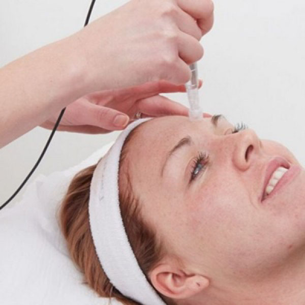MICRONEEDLING