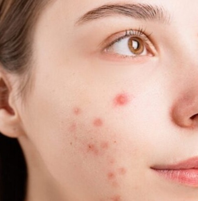 Advanced acne treatments at the skin clinic in bishop's stortford, Hertfordshire