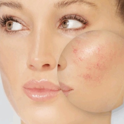 rosacea treatments in hertfordshire and essex rosacea treatments in hertfordshire and essex