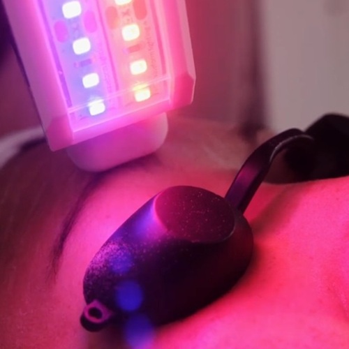 crystal clear resurface and heal microdermabrasion, Hertfordshire clinic