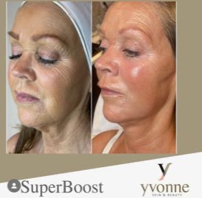 best anti ageing treatments in hertfordshire