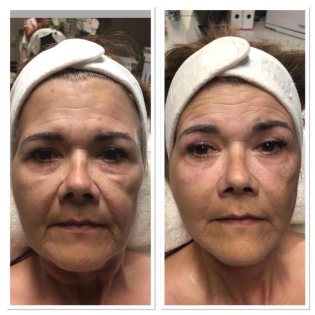 superboost facials at best skin clinic in Hertfordshire