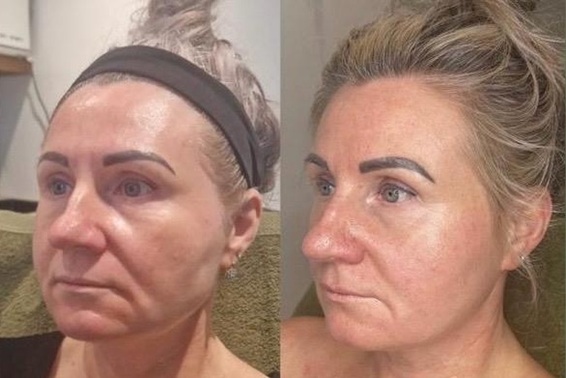 SUPERBOOST FACIALS AT BEST SKIN CLINIC IN HERTFORDSHIRE SUPERBOOST FACIALS AT BEST SKIN CLINIC IN HERTFORDSHIRE