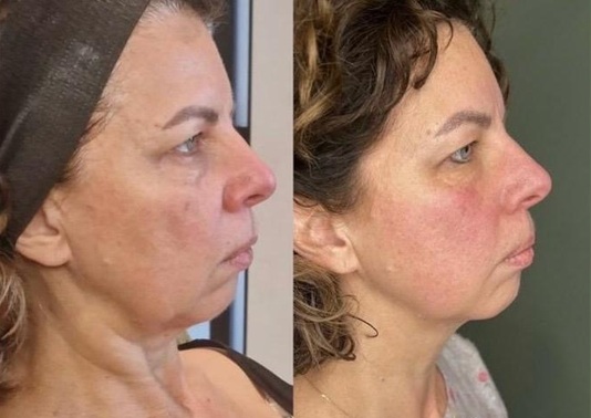 SUPERBOOST FACIALS AT BEST SKIN CLINIC IN HERTFORDSHIRE SUPERBOOST FACIALS AT BEST SKIN CLINIC IN HERTFORDSHIRE