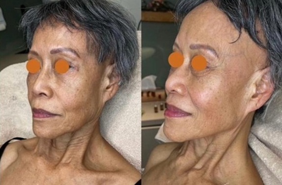 BEFORE AND AFTER SUPERBOOST AT URBAN SPA SKIN CLINIC IN HERTFORDSHIRE BEFORE AND AFTER SUPERBOOST AT URBAN SPA SKIN CLINIC IN HERTFORDSHIRE