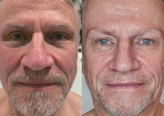 SUPERBOOST FACIALS AT BEST SKIN CLINIC IN HERTFORDSHIRE SUPERBOOST FACIALS AT BEST SKIN CLINIC IN HERTFORDSHIRE