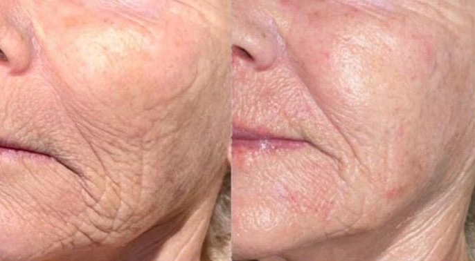 SUPERBOOST INTELLIGENT FACIALS IN HERTFORDSHIRE AND ESSEX SUPERBOOST INTELLIGENT FACIALS IN HERTFORDSHIRE AND ESSEX